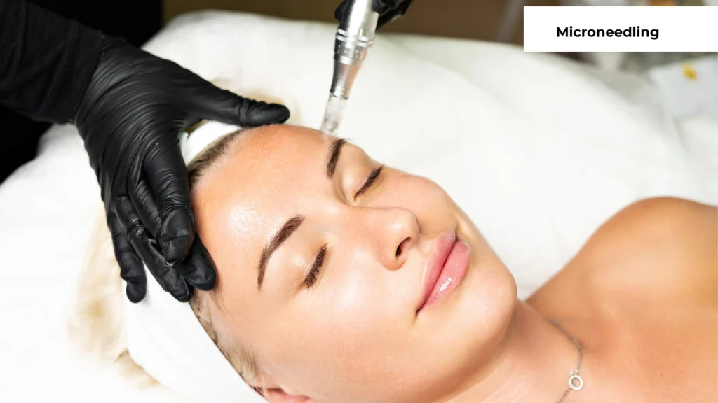 MICRONEEDLING PICTURE